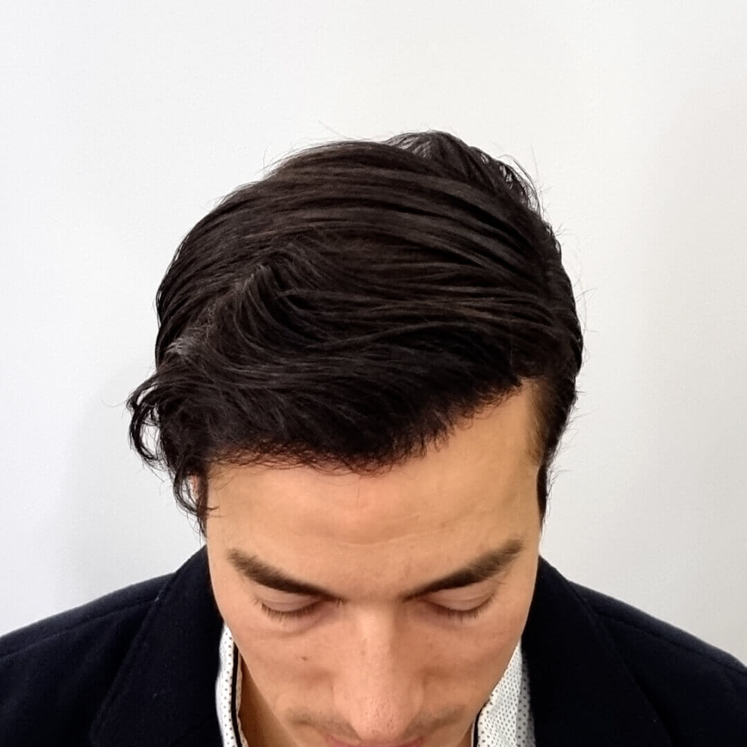 Which Hair Transplant Method is the Best in 2025