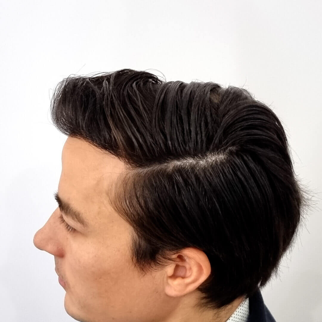 Which Hair Transplant Method is the Best in 2025