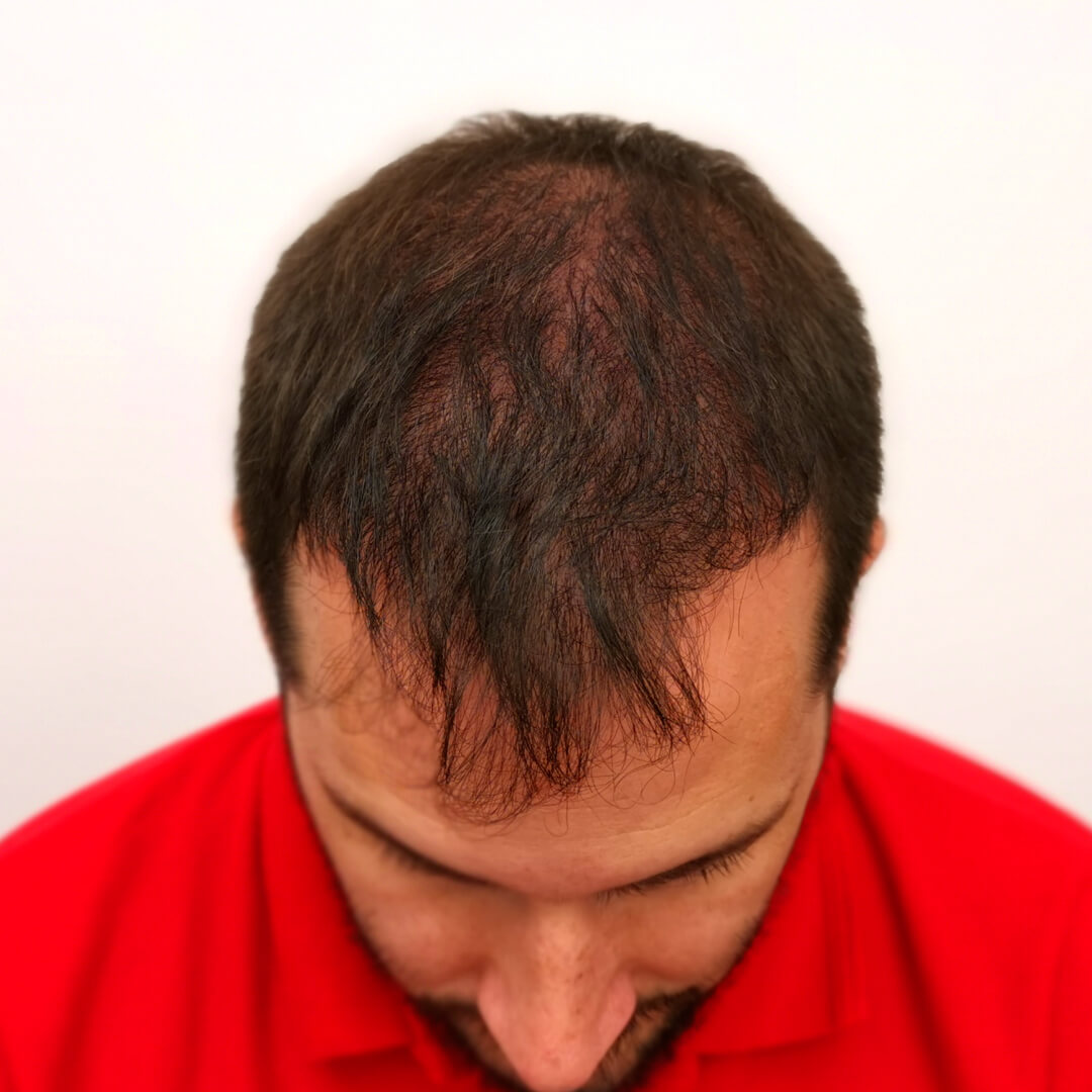 Hair transplant before-after: Norbert - PHAEYDE Clinic