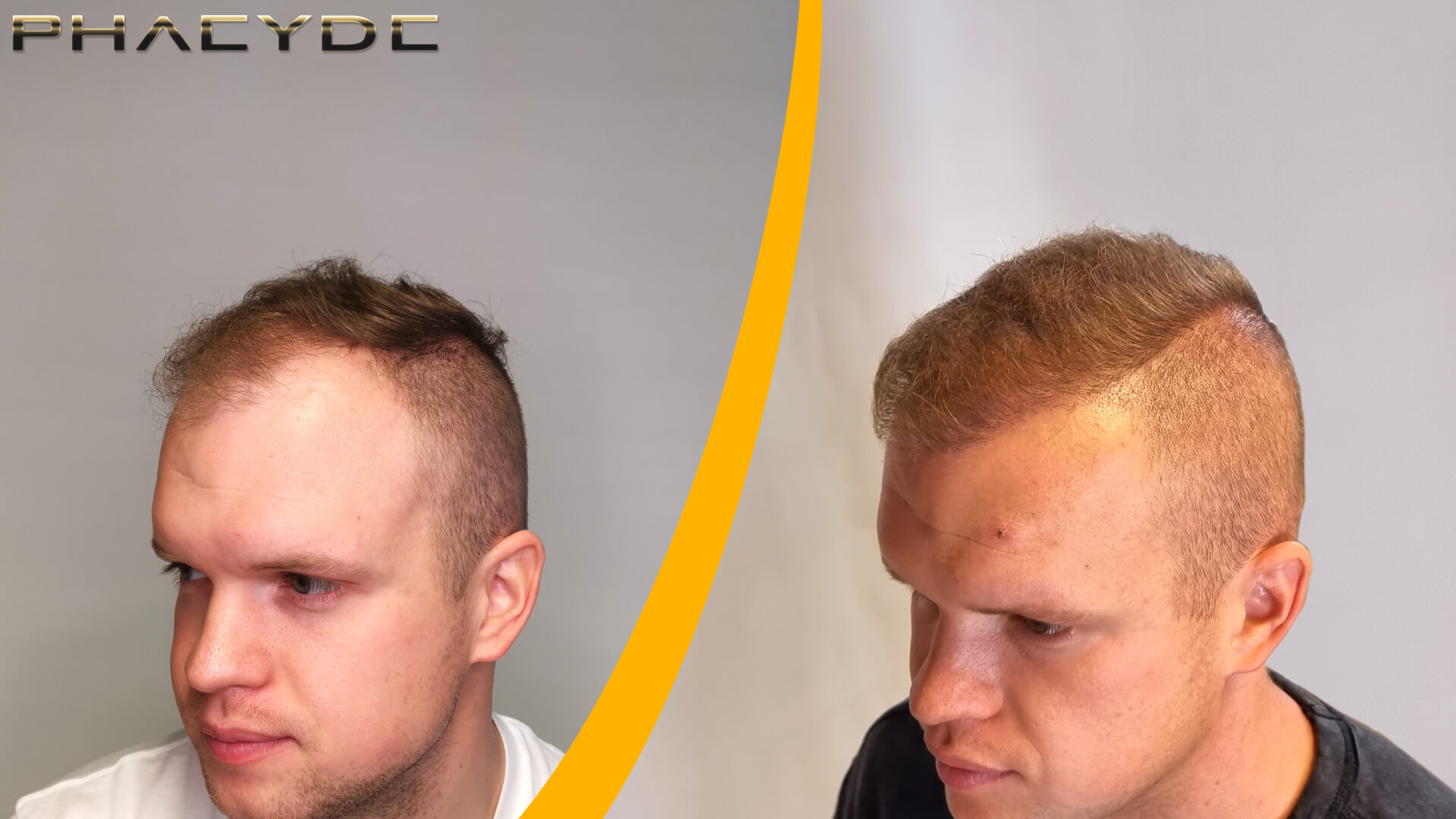 Patrik: Before-After Hair Transplantation