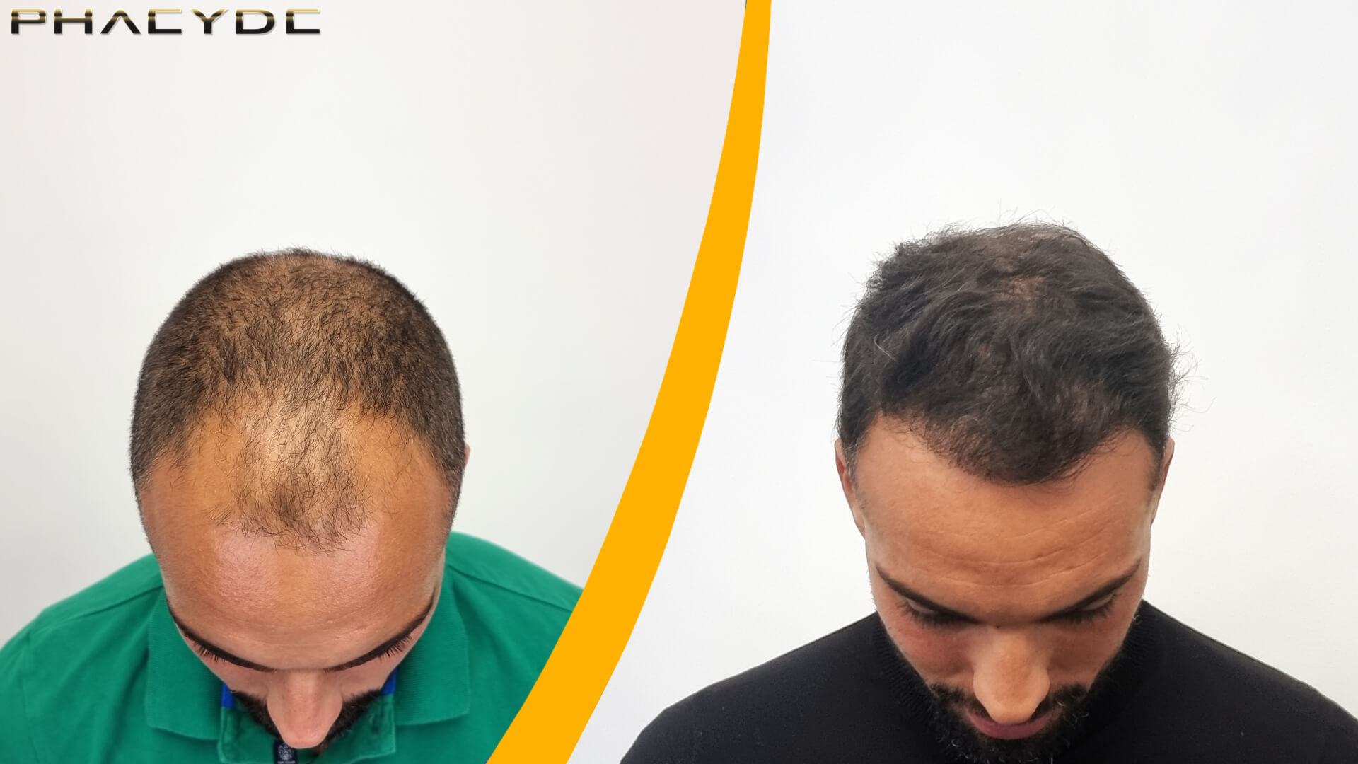 Hair Transplant Result Before-After