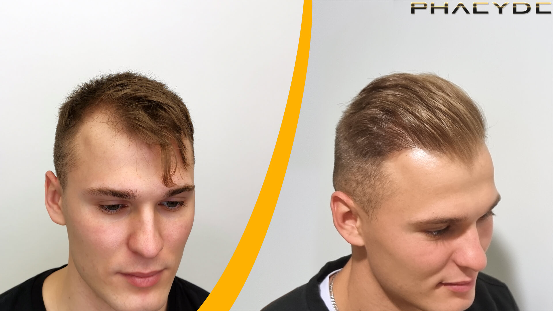 Hair Transplant Before & After Result