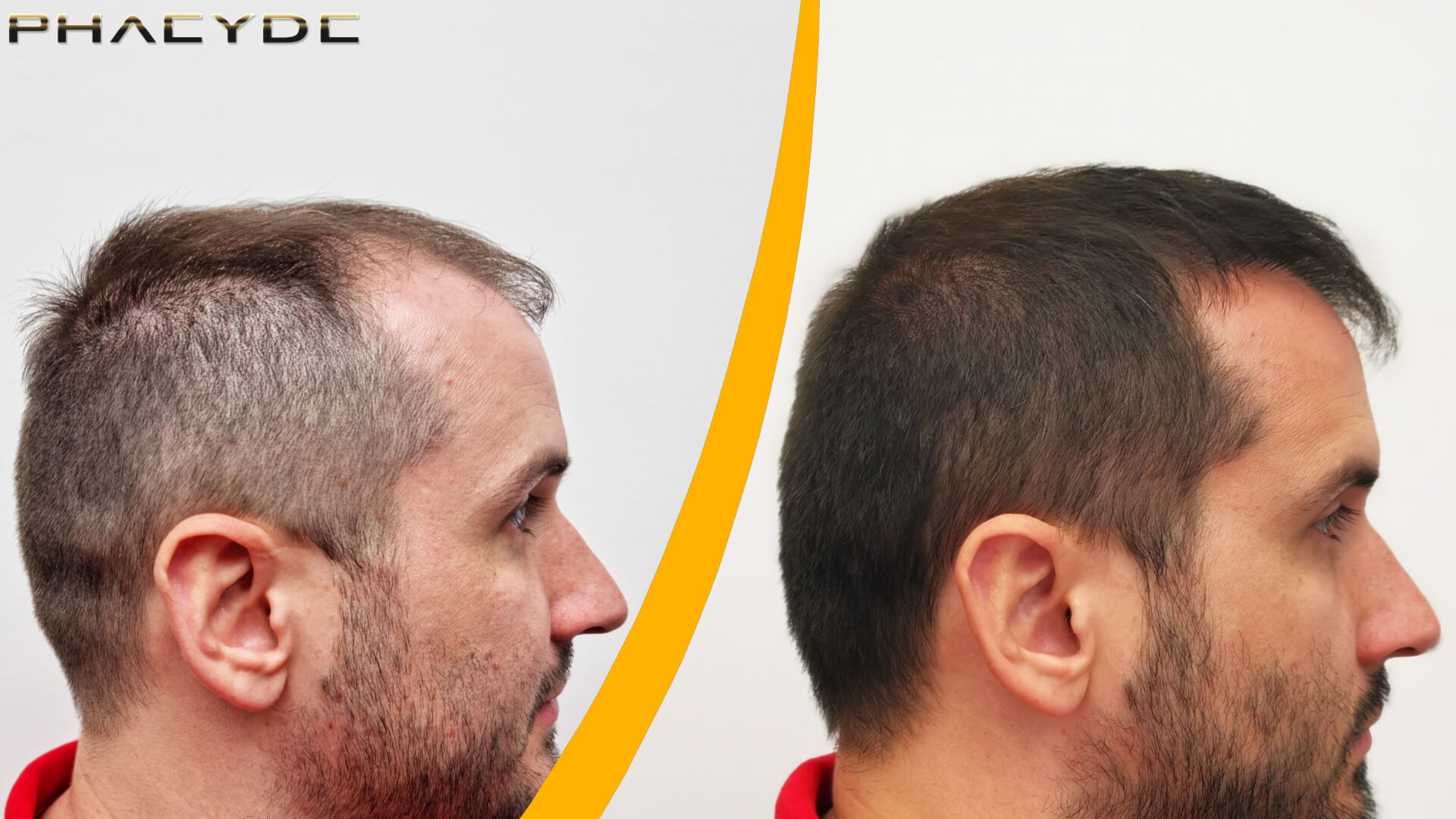 Before and After Hair Transplant