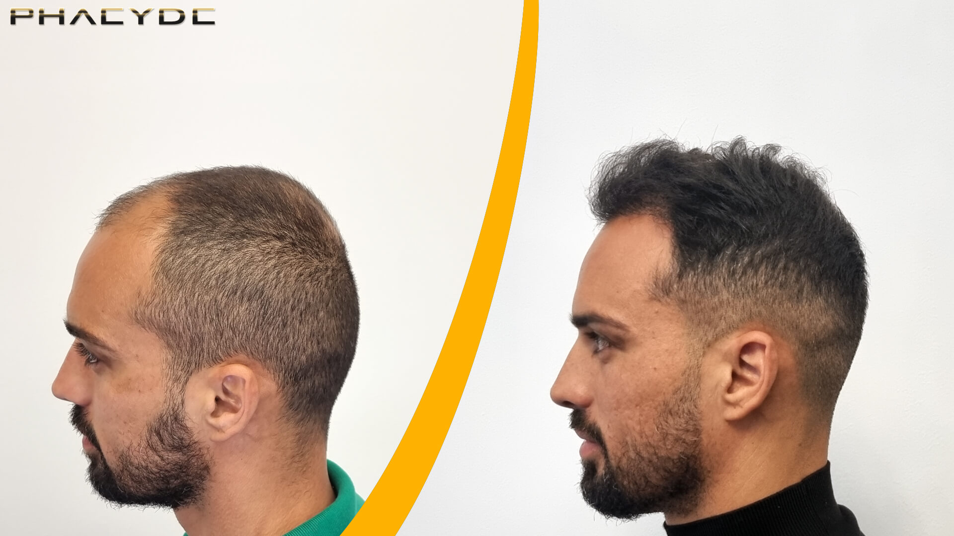 Hair Transplant – Before & After result