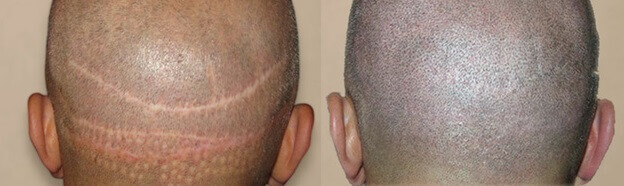 SMP (Scalp Micro Pigmentation) before and after
