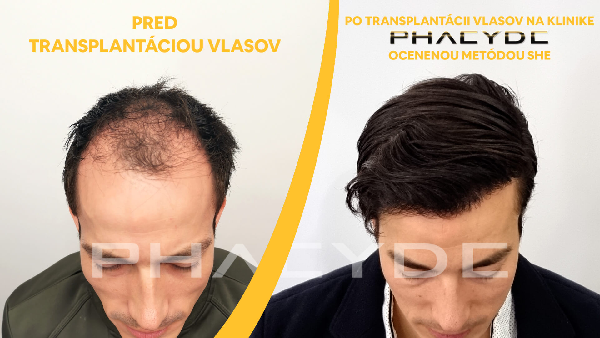 Gergő Before and After Hair Transplant – 9800+ Transplanted Hairs