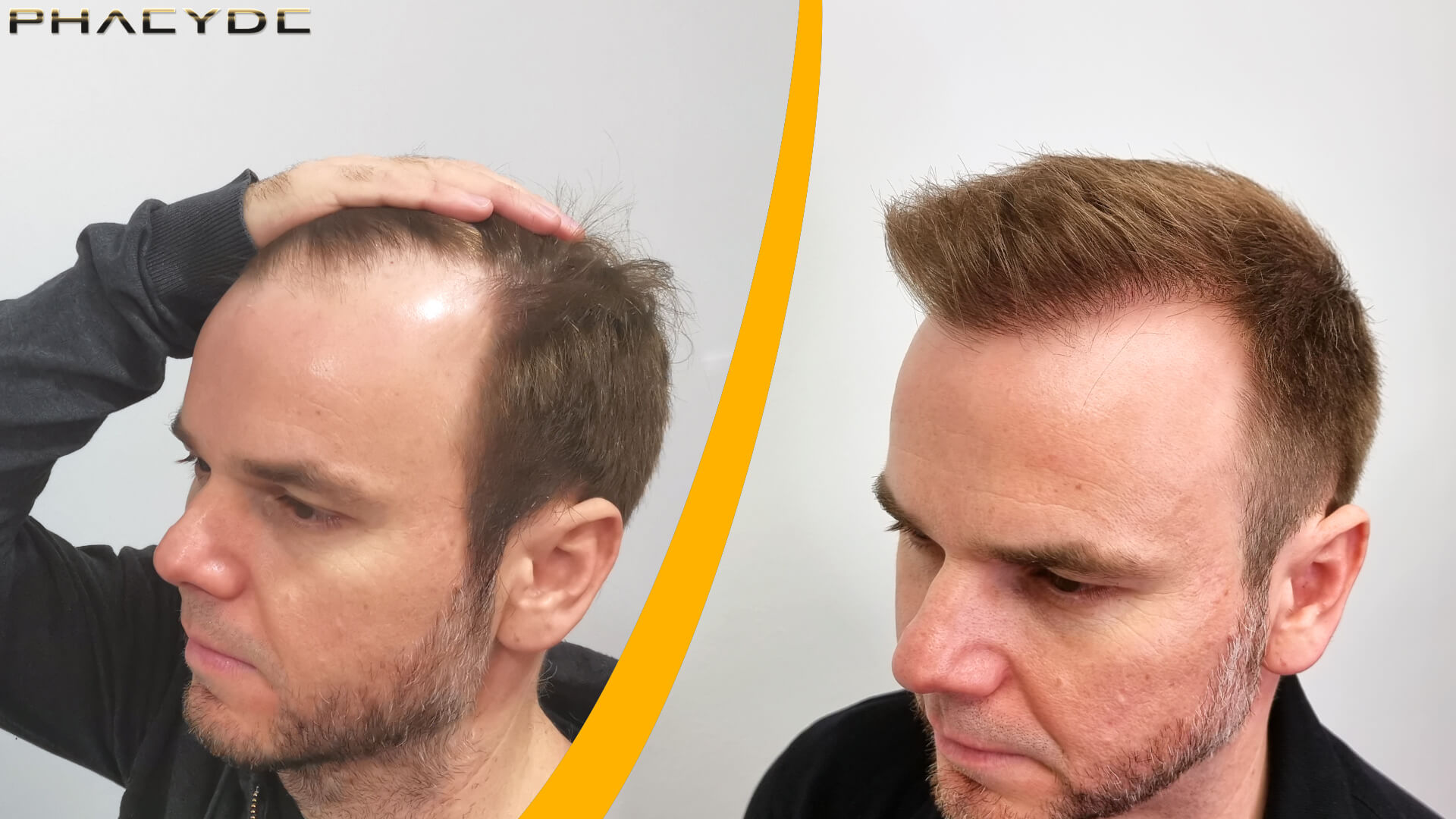Hair Transplant – Before & After result