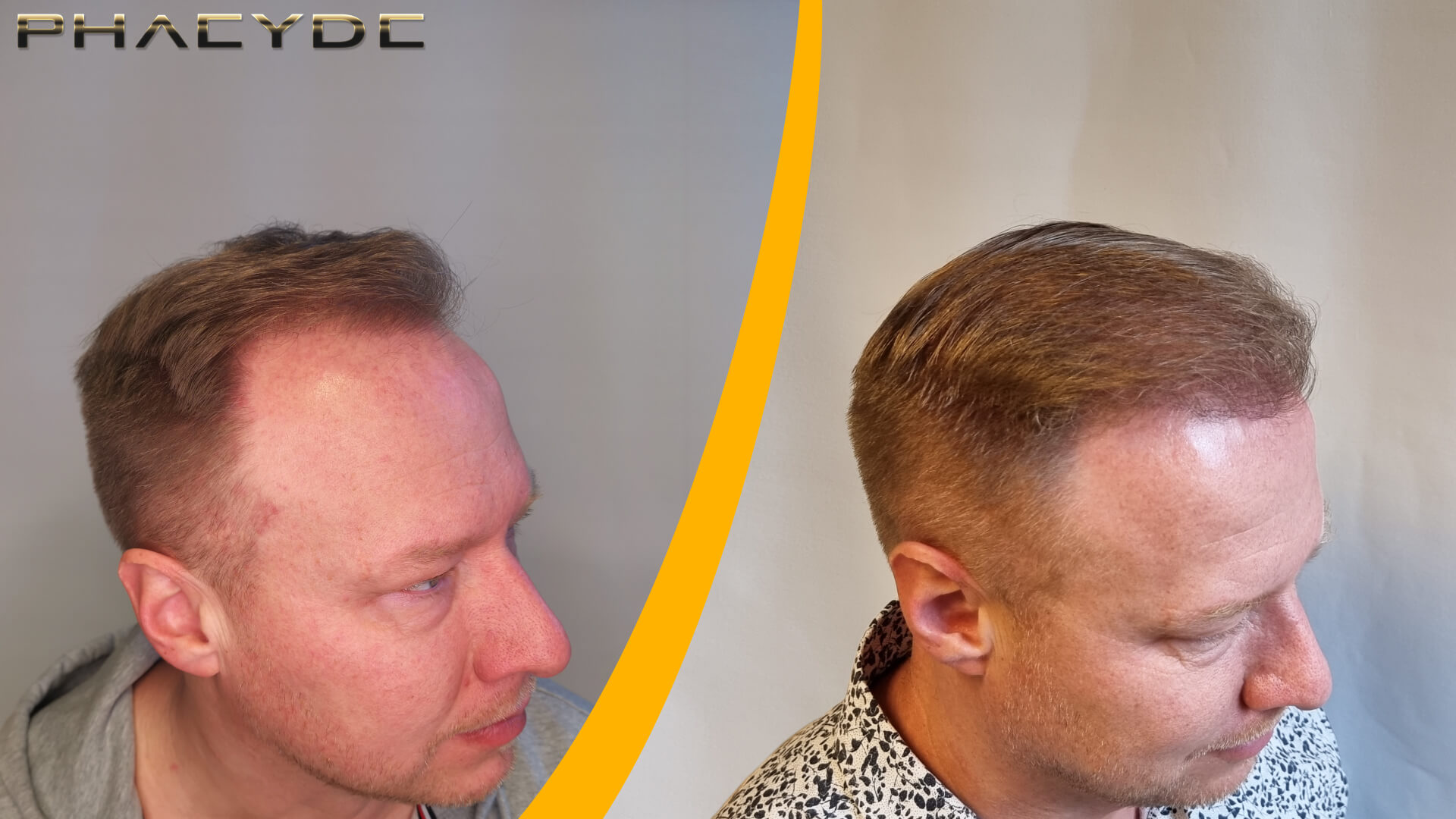 Before & After Hair Transplant – 1600 Grafts