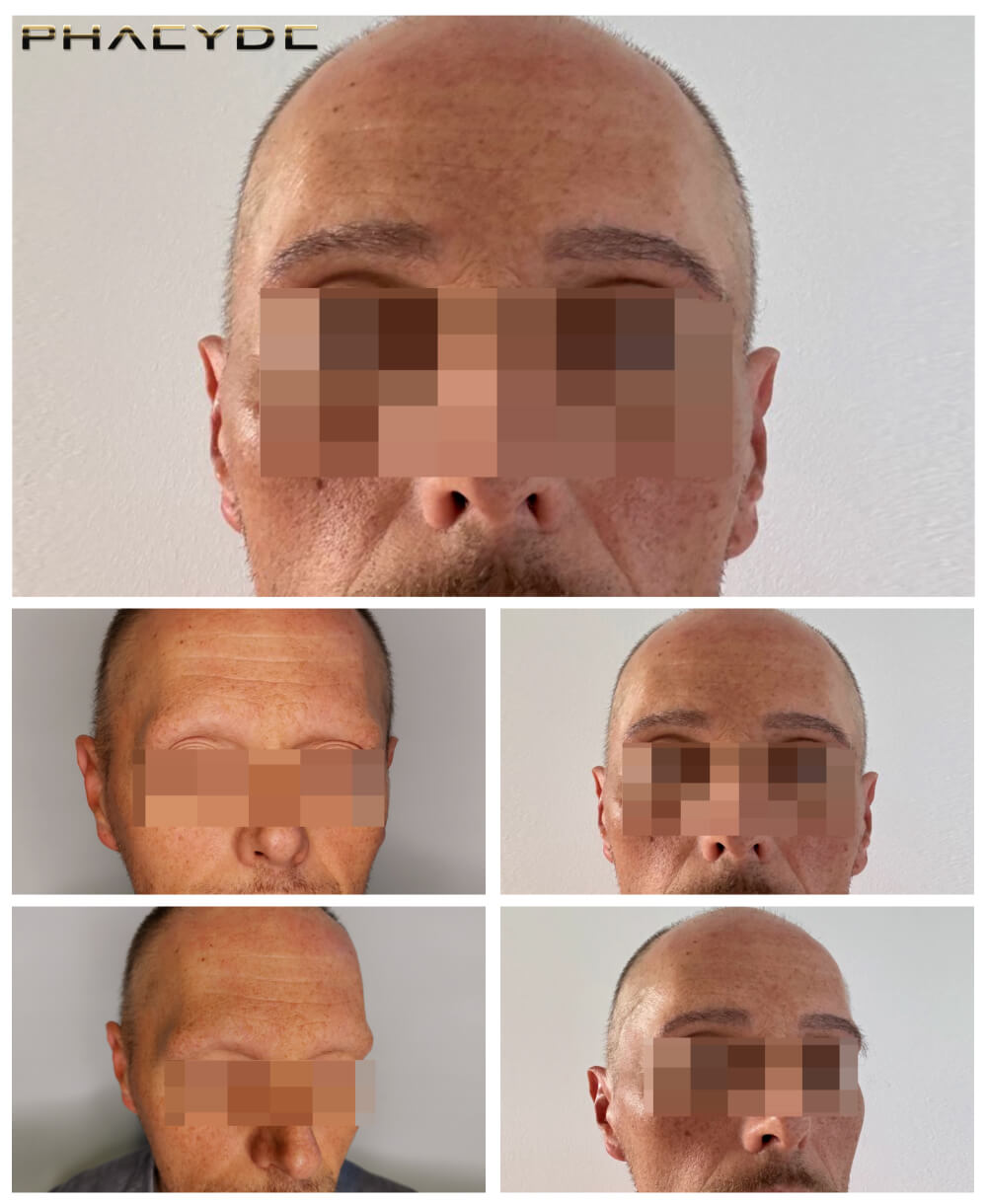 Eyebrow Transplantation