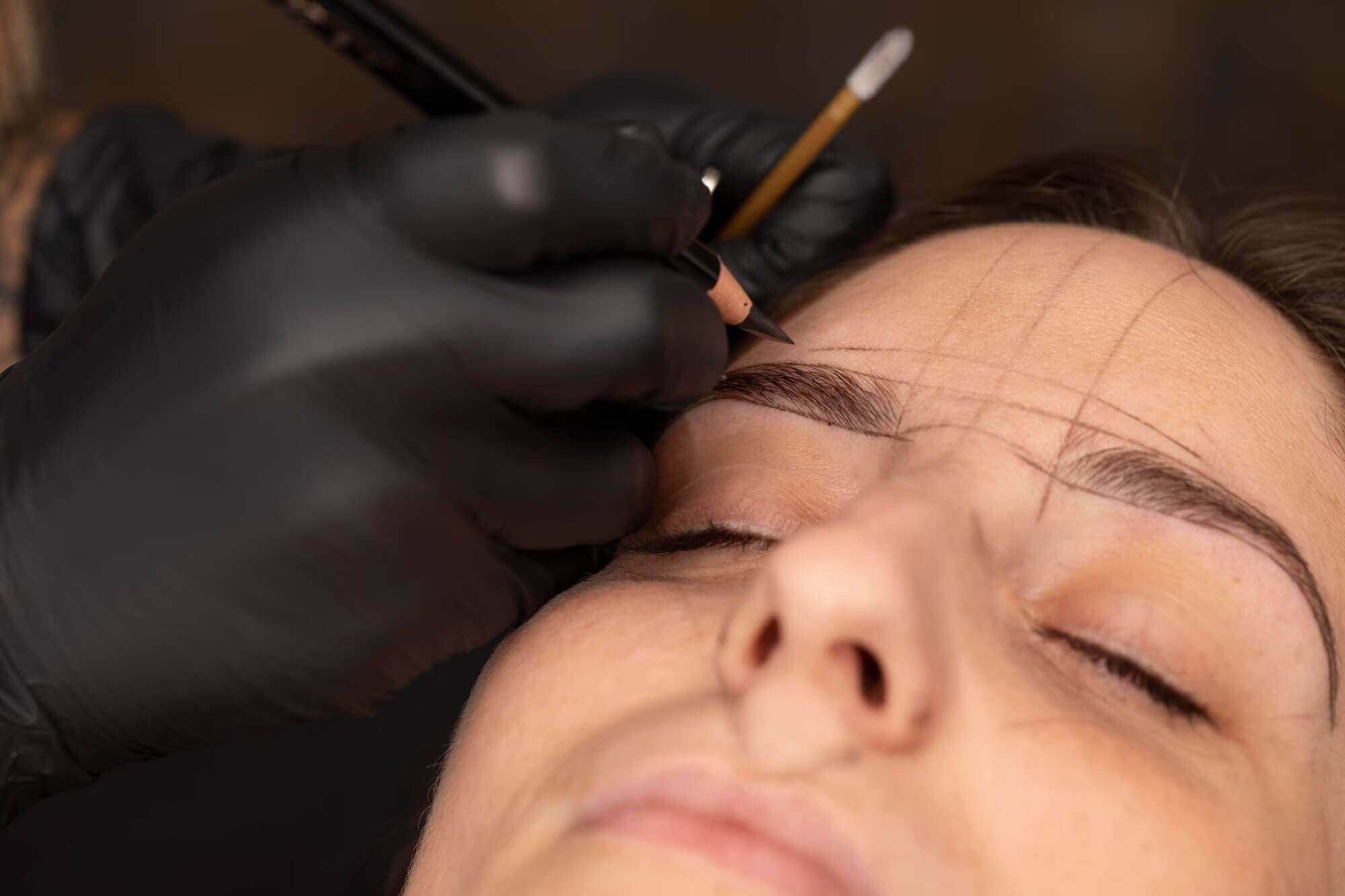 Eyebrow Transplantation
