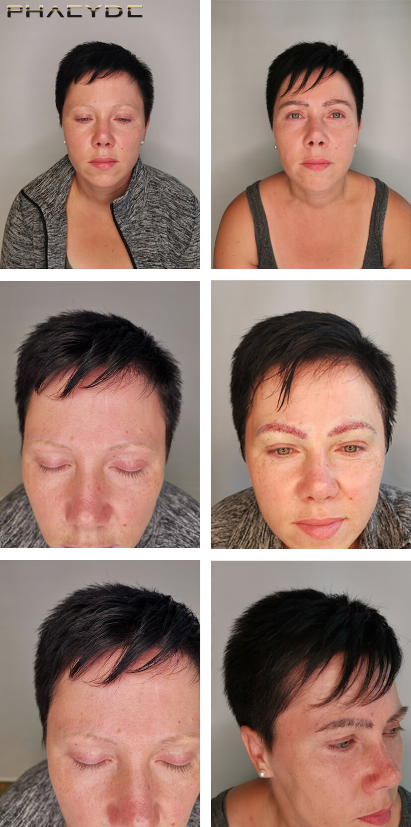 Eyebrow Transplantation