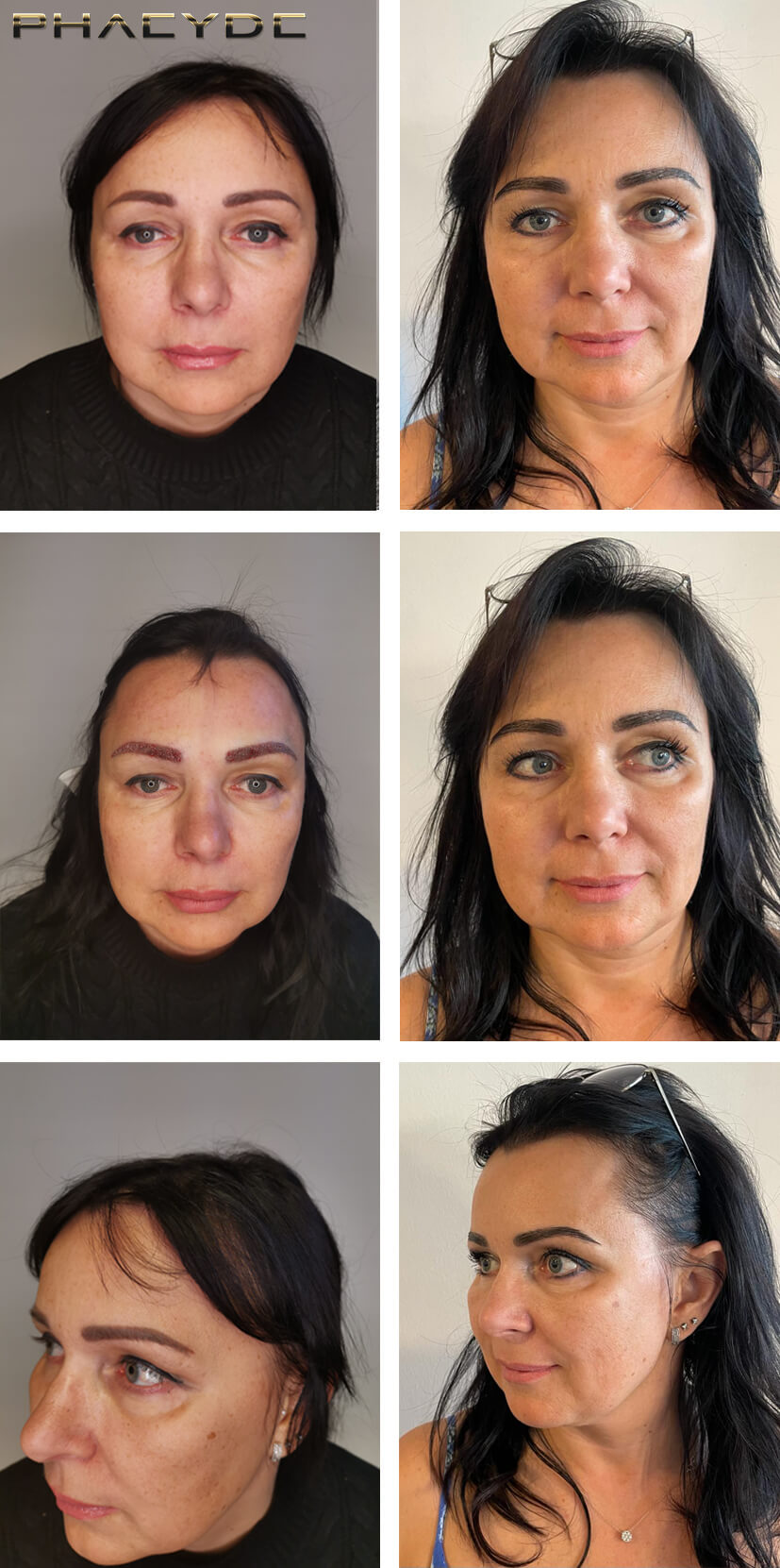 Eyebrow Transplantation