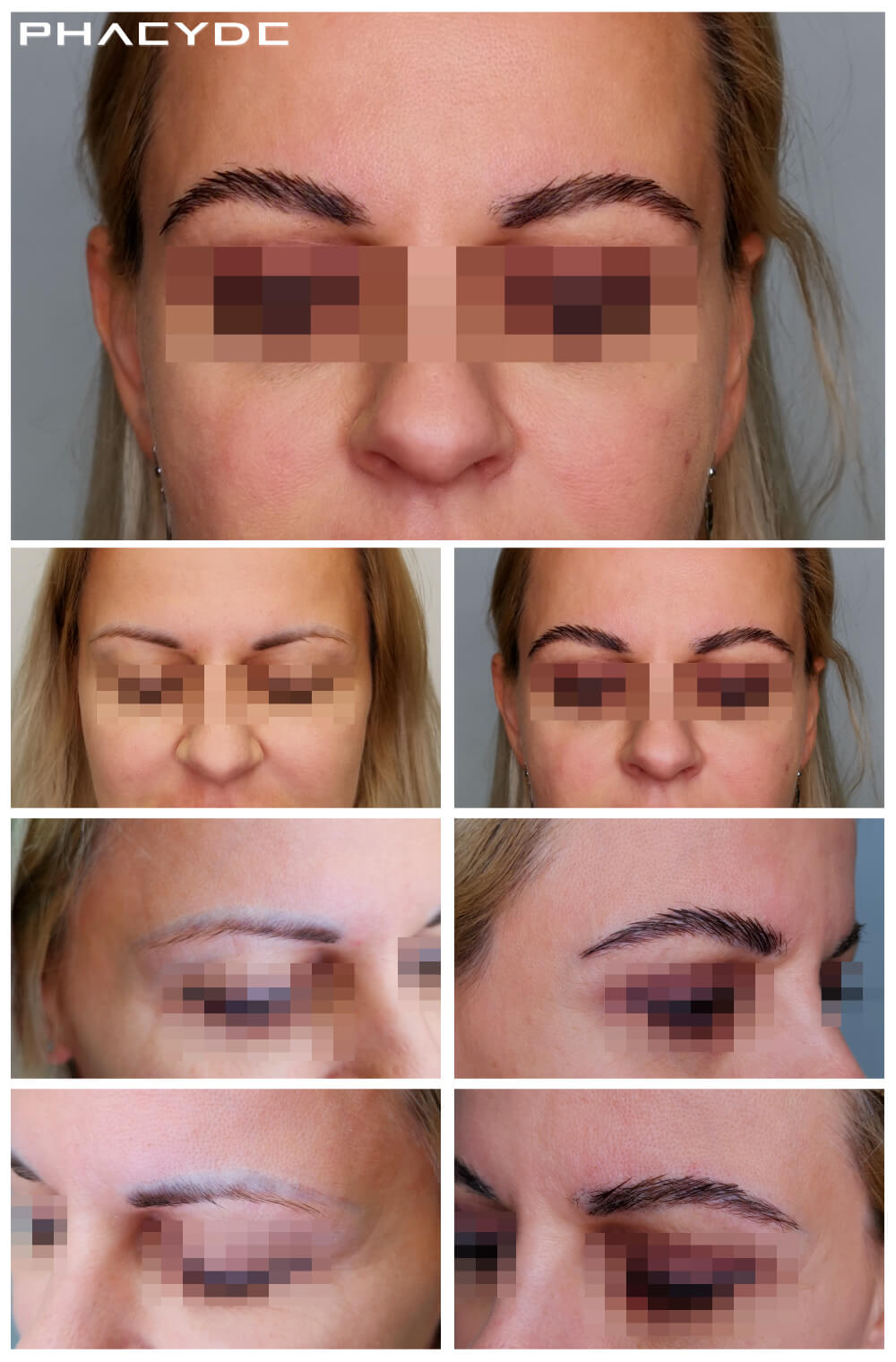 Eyebrow Transplantation