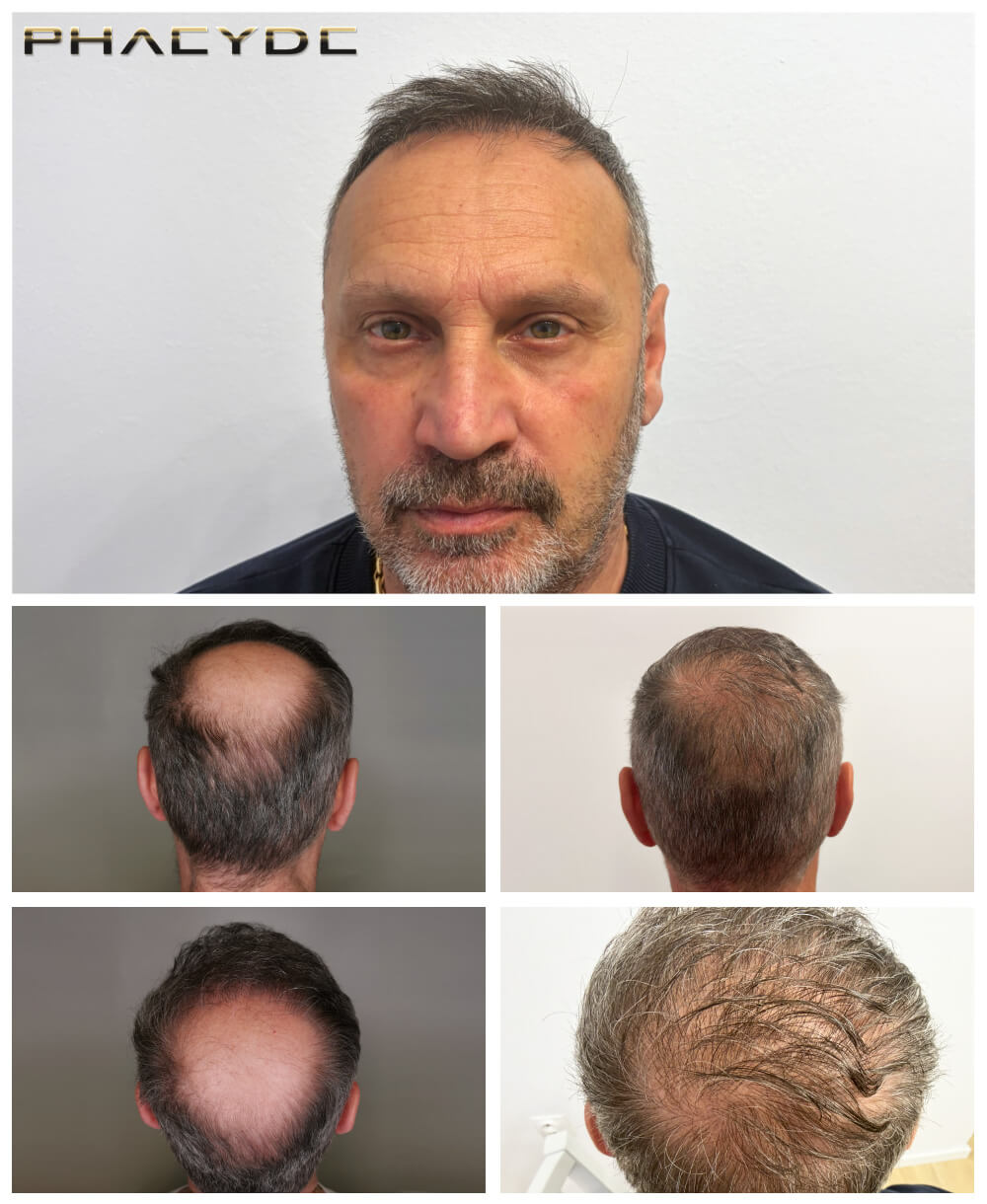 Robert - 2500 + 2200 Grafts